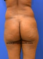 Brazilian Buttock Lift