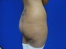 Brazilian Butt Lift