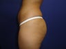 Brazilian Butt Lift