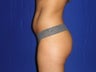 Brazilian Butt Lift