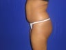 Brazilian Butt Lift