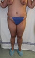 Brazilian Butt Lift