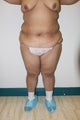 Liposuction