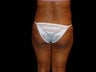 Buttocks Augmentation