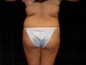 Buttocks Augmentation