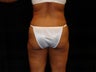 Buttocks Augmentation