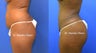 Brazilian Buttock Lift