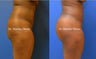 Brazilian Buttock Lift