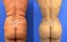 Brazilian Buttock Lift