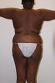 Brazilian Butt Lift