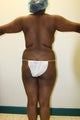 Brazilian Butt Lift