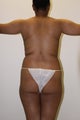 Brazilian Butt Lift