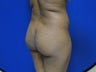 Brazilian Butt Lift/Fat Grafting Buttock Augmentation