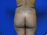 Brazilian Butt Lift/Fat Grafting Buttock Augmentation