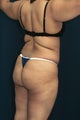 Brazilian Butt Lift surgery (liposuction to multiple areas and fat grafting to buttock)
