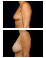 Breast Augmentation