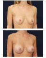 Breast Augmentation