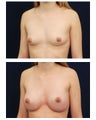 Breast Augmentation