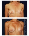 Breast Augmentation