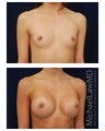 Breast Augmentation