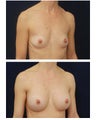 Breast Augmentation