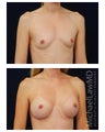 Breast Augmentation