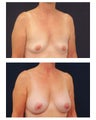 Breast Augmentation