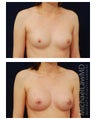 Breast Augmentation