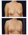 Breast Augmentation with Lift