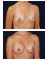 Breast Augmentation