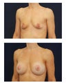 Breast Augmentation with Lift
