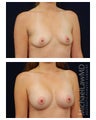 Breast Augmentation