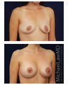Breast Augmentation