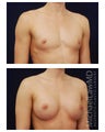 Breast Augmentation