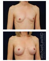 Breast Augmentation