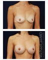 Breast Augmentation