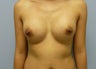 Breast Augmentation with Silicone Gel Implants