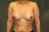 Women's Breast Augmentation: Enlarge and Minilift