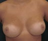 Breast Augmentation