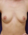 Breast Augmentation