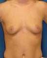 Breast Augmentation