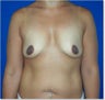 Breast Augmentation