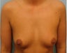 Breast Augmentation with Silicone Implants