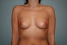 Bilateral Breast Augmentation