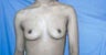 Breast Augmentation