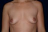 Breast Augmentation