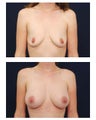 Breast Augmenation