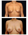 Breast Augmentation