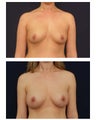 Breast Augmentation