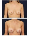 Breast Augmentation